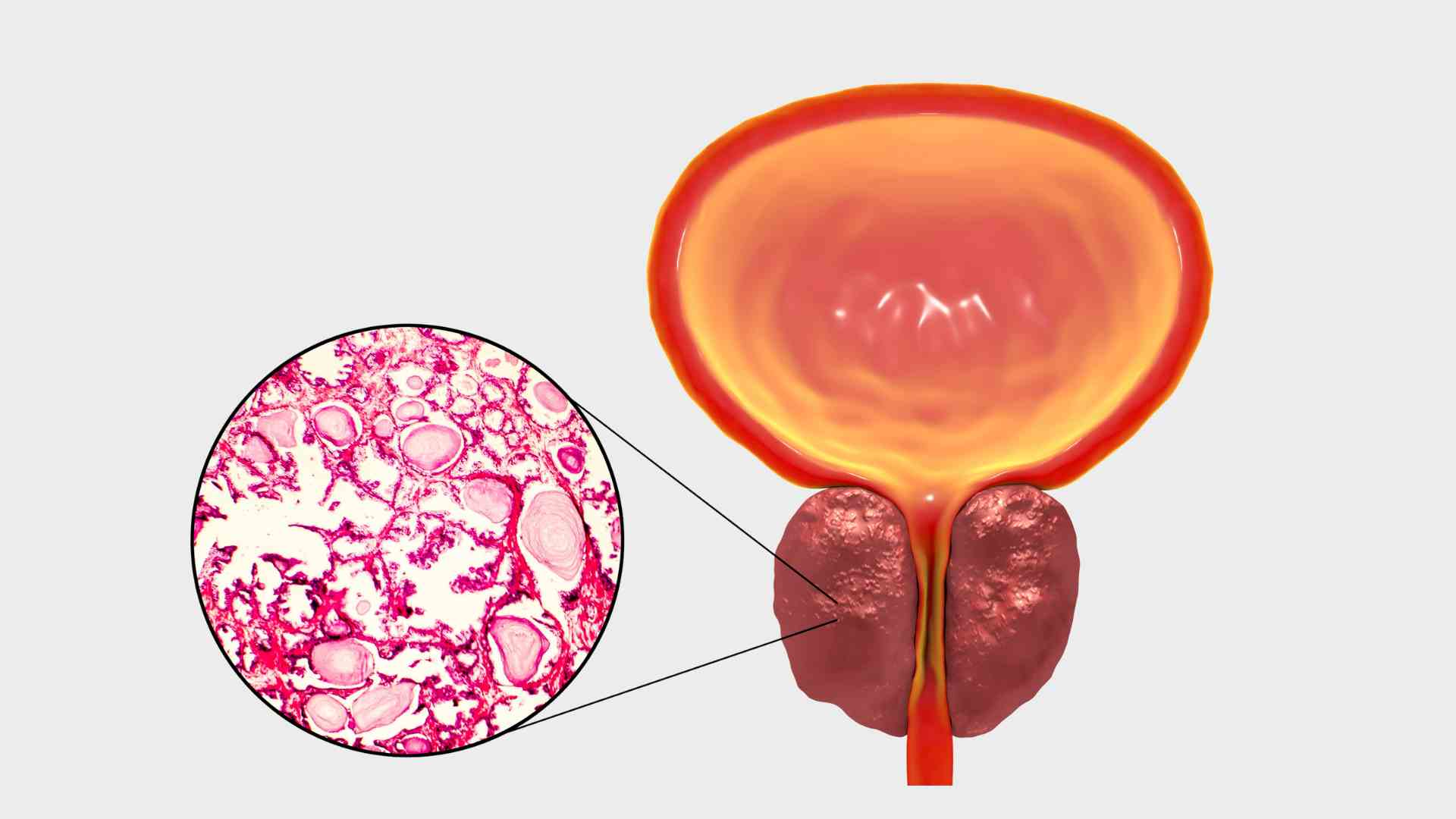 Sintomas da Hiperplasia Prostática